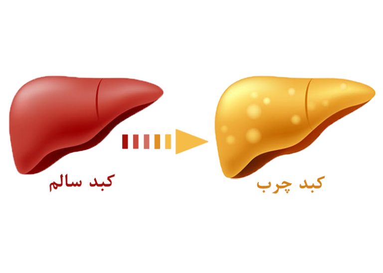 بررسی بیماری کبد چرب و استفاده از عصاره گیاهی لیورتراپین برای درمان آن